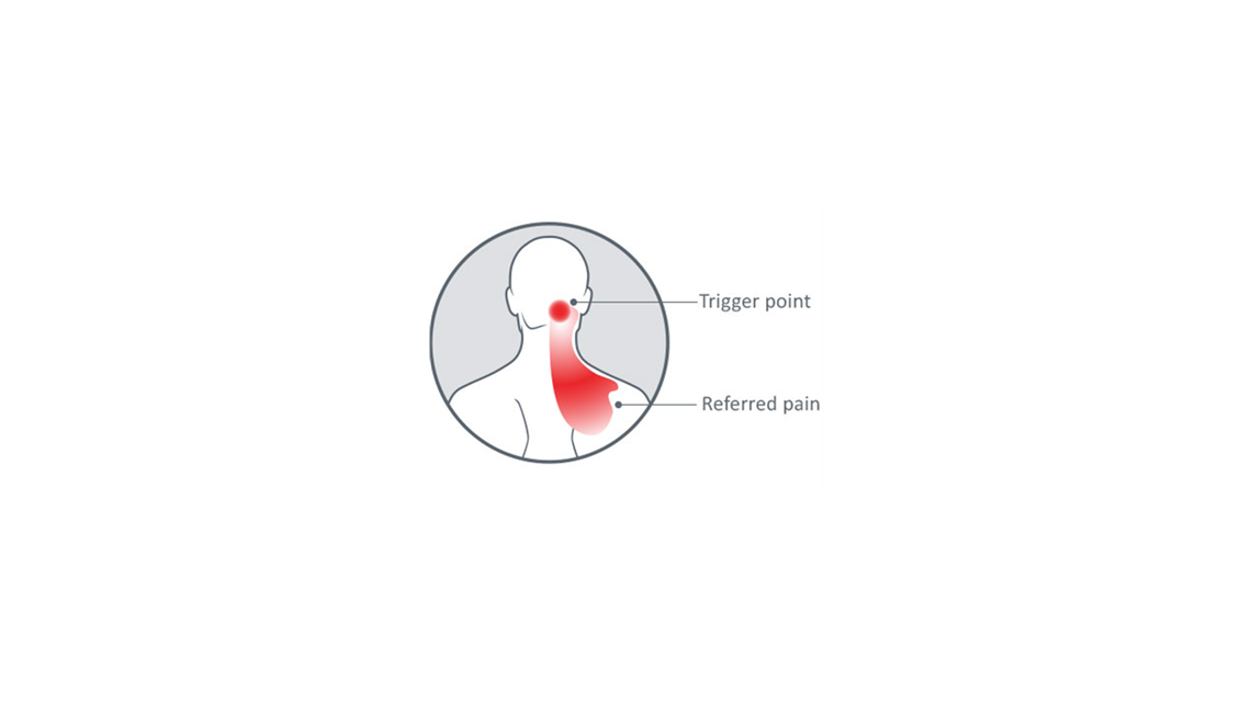 The source of common headache pain