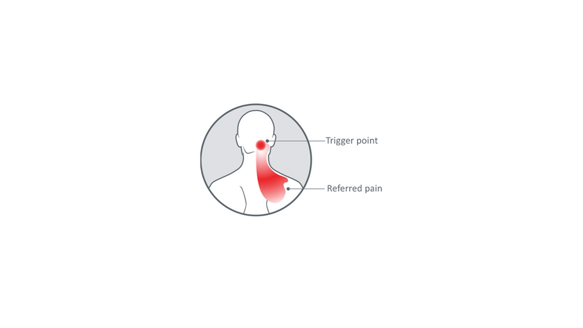 The source of common headache pain