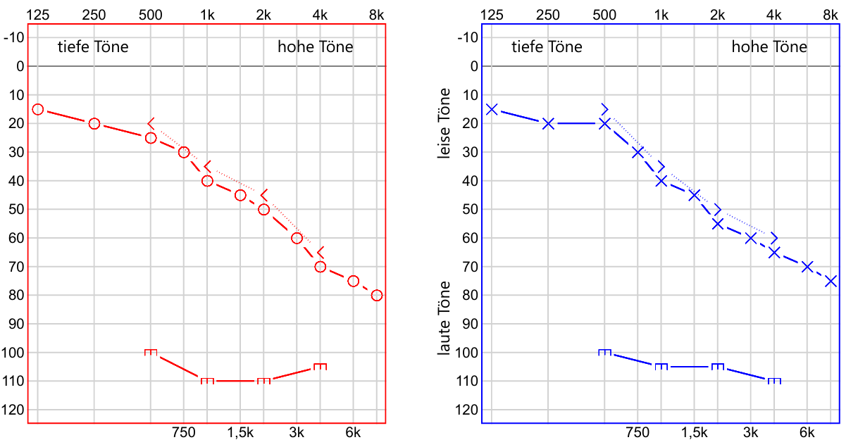 audiogramm-hoerverlust-tiefe-hohe-toene.png