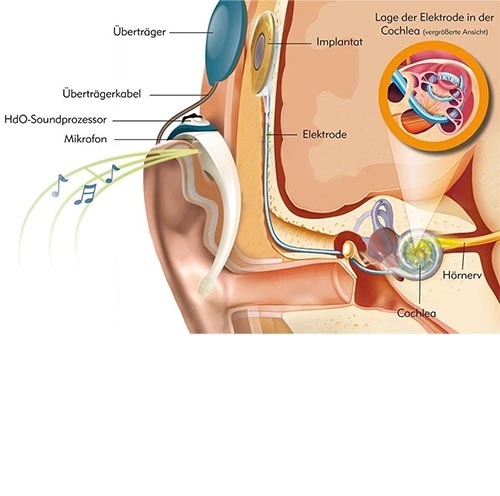 Cochlea-Implantat-Grafik.jpg
