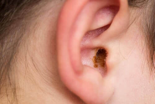 image-of-earwax-in-entrance-of-ear-canal.jpg