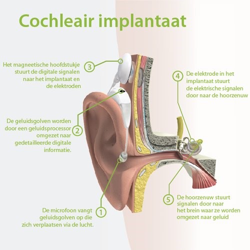 cochlear-implant_-dutch.jpg
