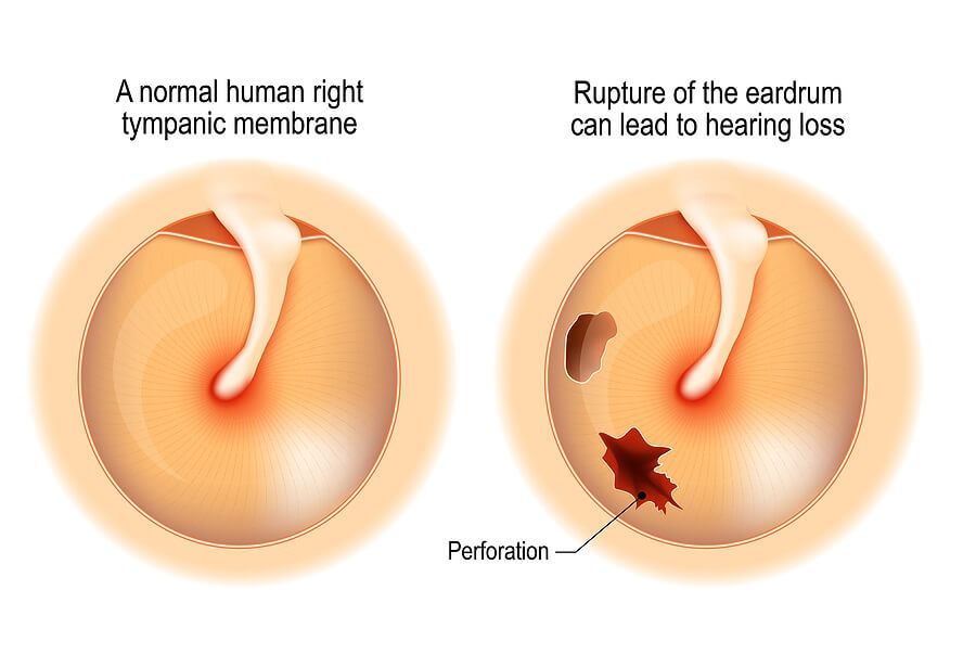 ruptured-eardrum.jpg