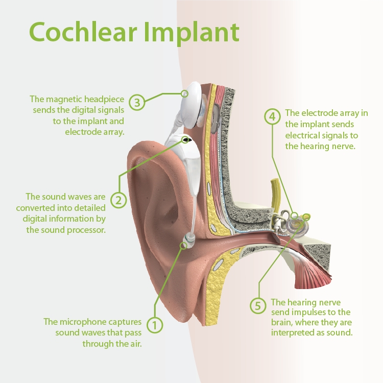 cochlear-implant.jpg
