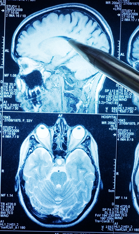 HH_acoustic-neuroma_MOBILE.jpg