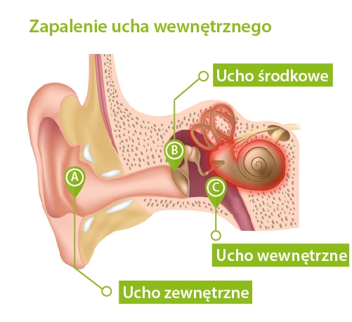 zapalenie_ucha_wewnetrznego_pl.jpg