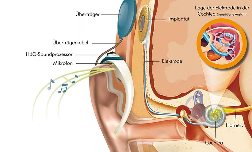 cochlea-implantat-erklaergrafik.jpg