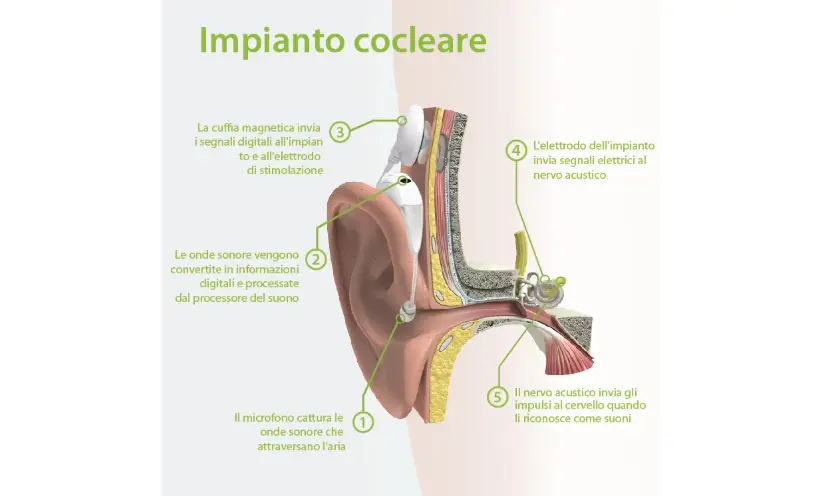 cochlear-implant_it_cochlear-implant_it-822-496.webp