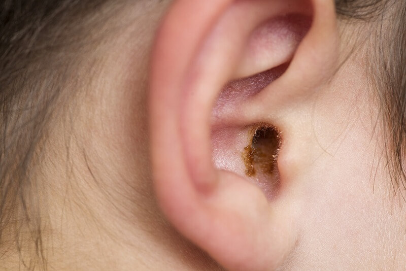 earwax-in-the-ear.jpg