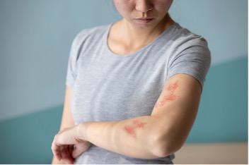 Rash.jpg