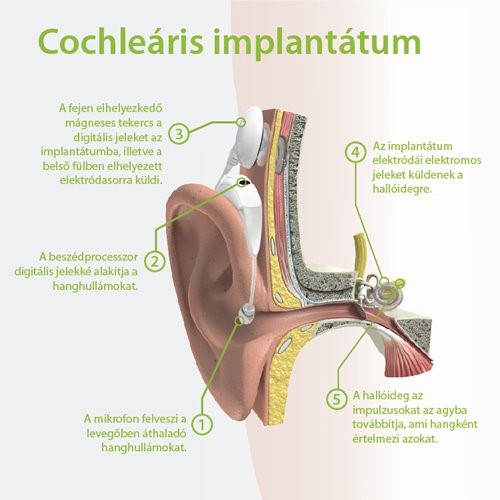 cochlear-implant_hu.jpg