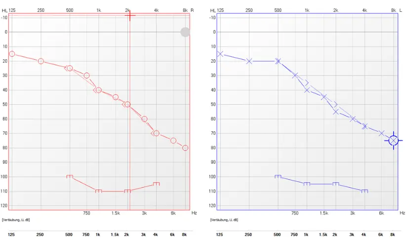 Darstellung eines Audiogrammes vom rechten Ohr in der Farbe rot und vom linken Ohr in der Farbe blau