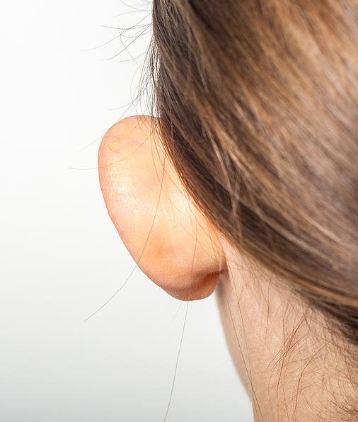 Tipos de otoplastia.jpg