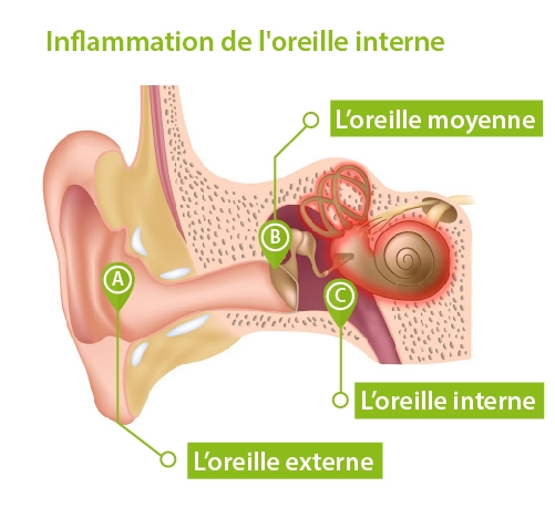 inflammation_de_l_oreille_interne.jpg