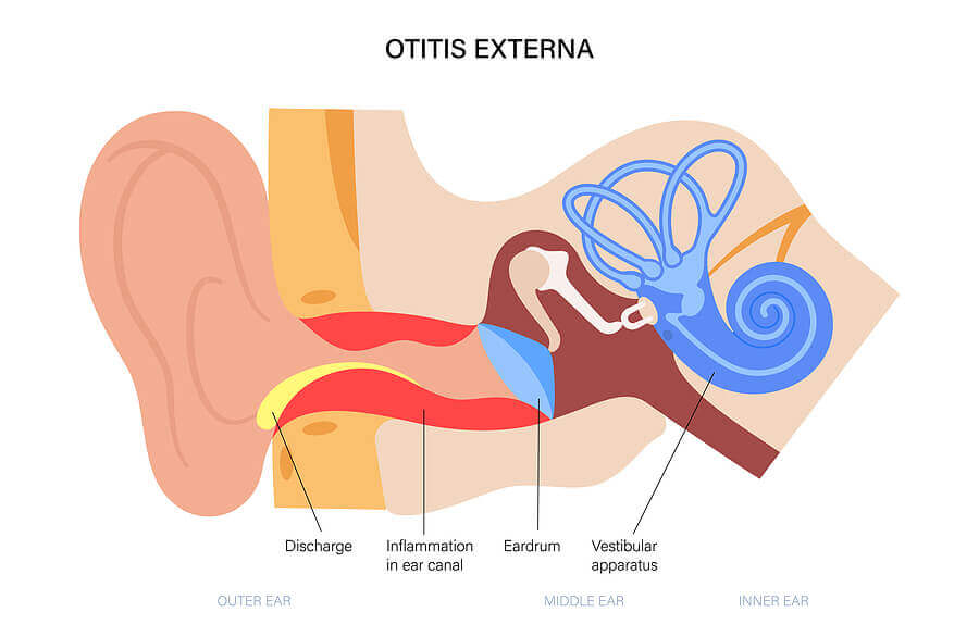 otitis-externa-swimmers-ear.jpg