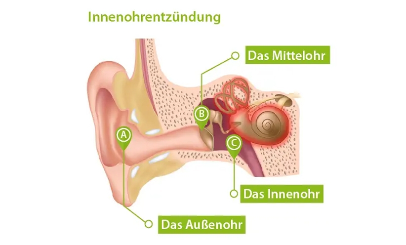 innenohrentzuendung.jpg