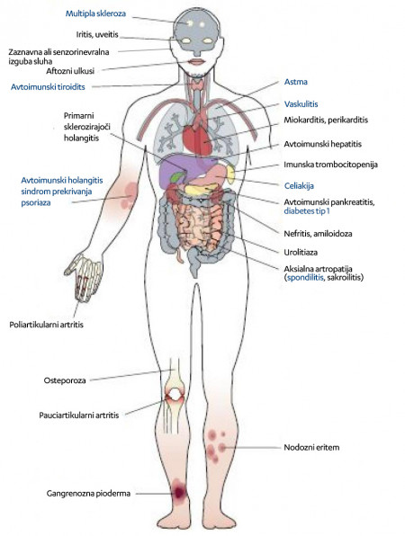 Crohn_About-disease_Vnetje_gastrointestinalnega_trakta.jpg