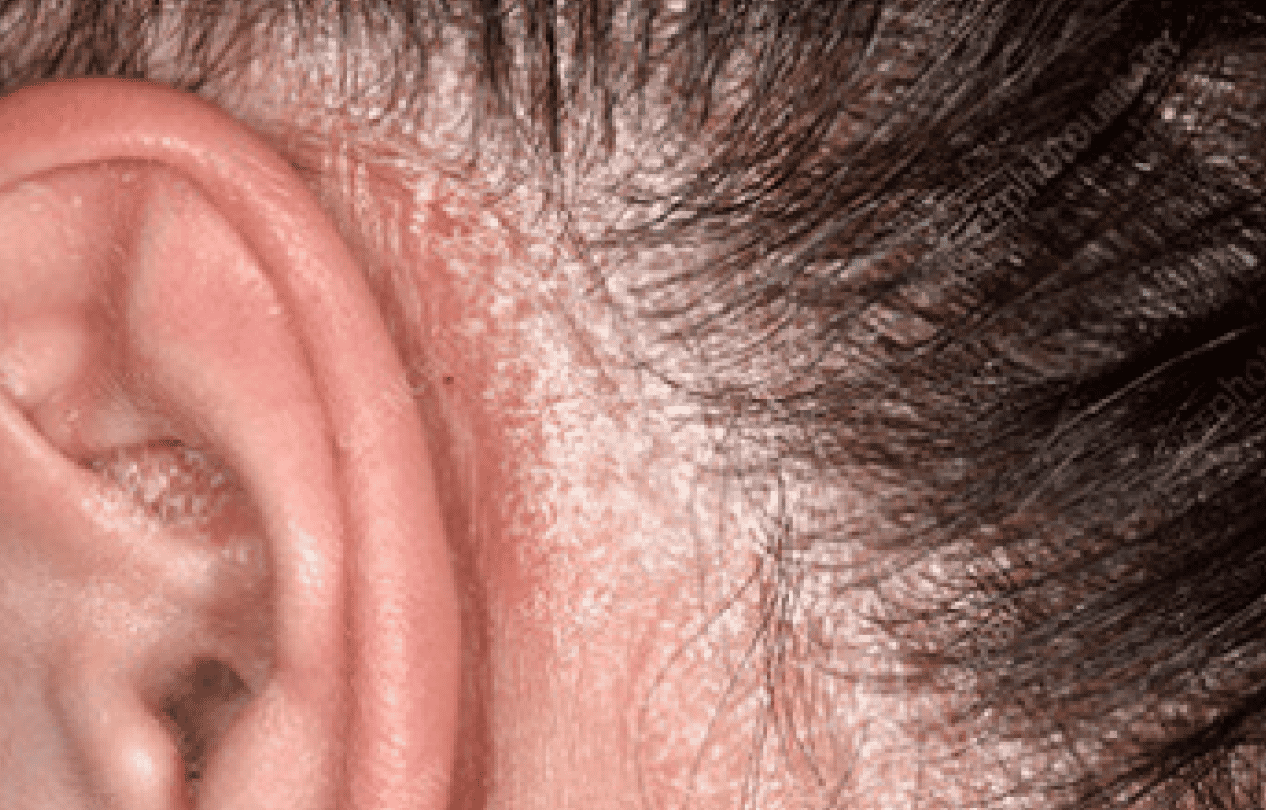 Luskavica v plakih Luskavica v plakih