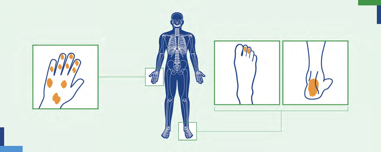 Vpliv psoriatičnega artritisa na telo