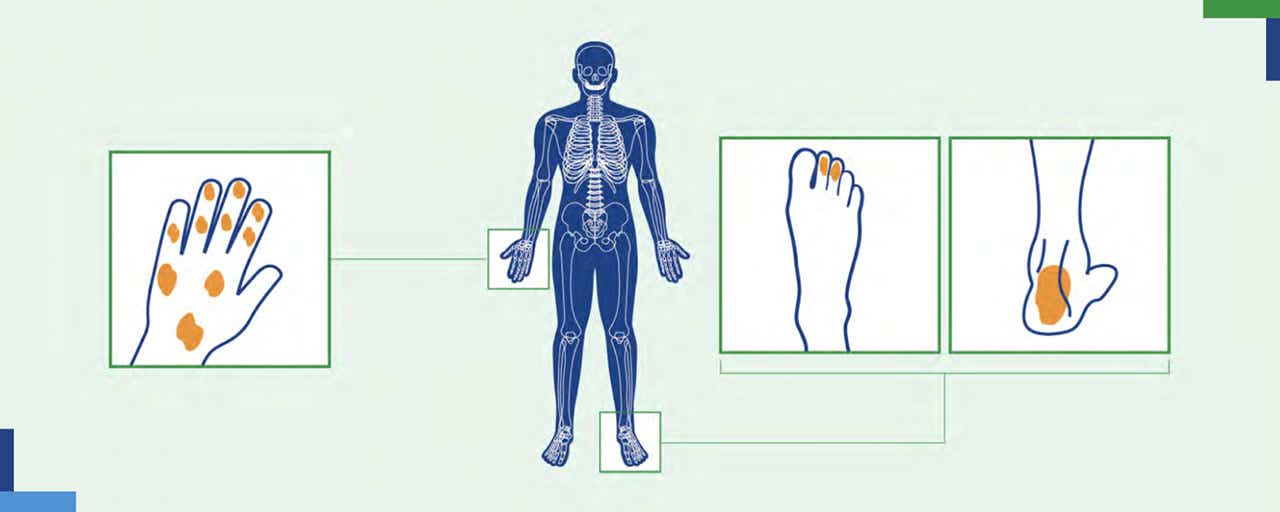 Vpliv psoriatičnega artritisa na telo Vpliv psoriatičnega artritisa na telo