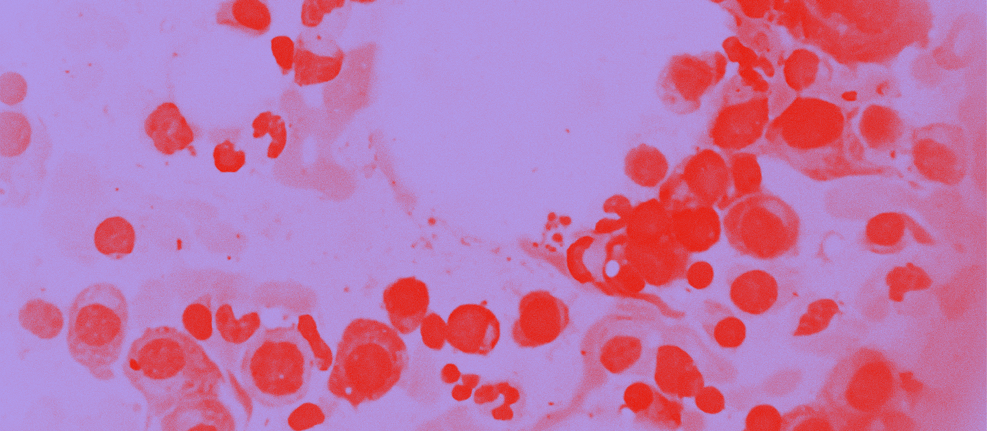 Multippeli myelooma