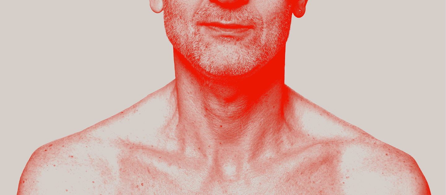 Manttelisolulymfooman diagnoosi ja hoito