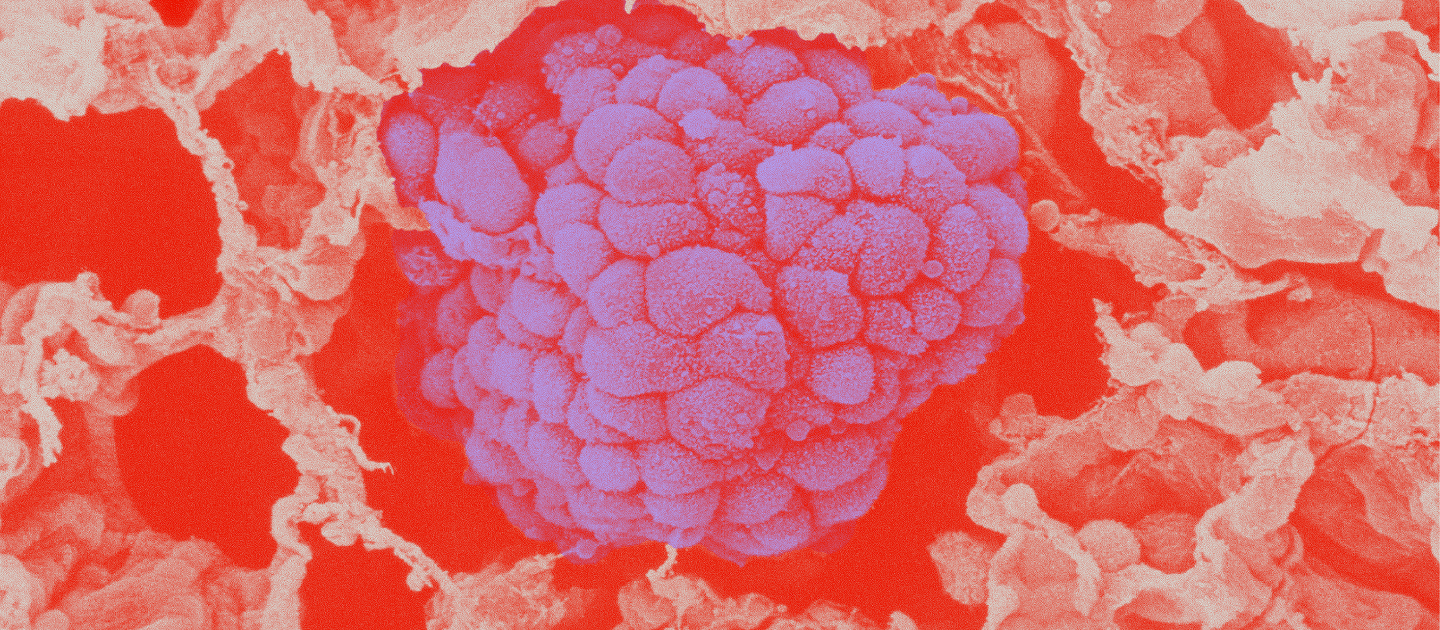 Mikä on keuhkosyöpä