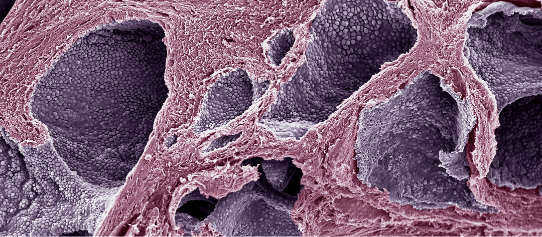 Mikä on eturauhassyöpä