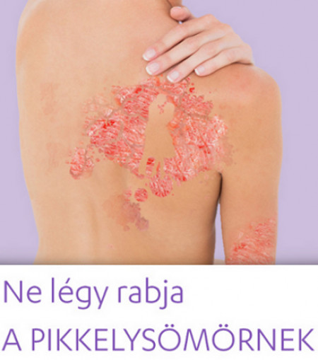 Psoriasis-Treatment_A_pszoriázis_kezelése_disease.jpg