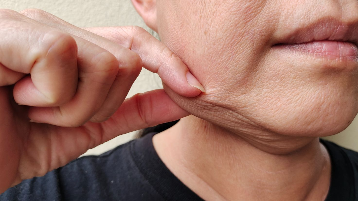 does tirzepatide cause acne GLP-1 Agonists Not Linked to the Development of Acne