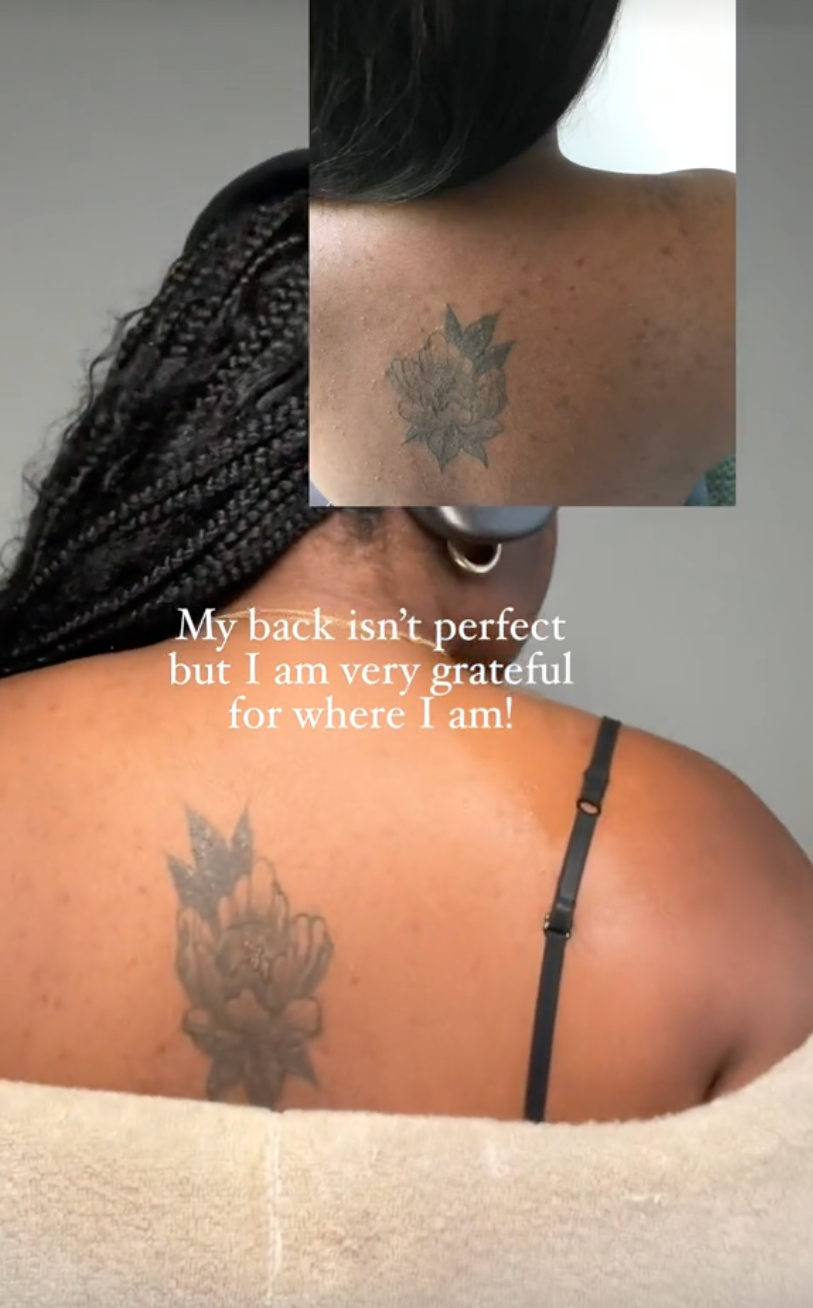 Body Acne System – Shield, image size:813x1308