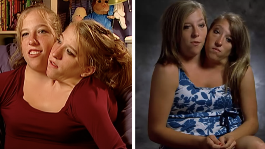 What Conjoined Twins Abby And Brittany Hensel Look Like Now