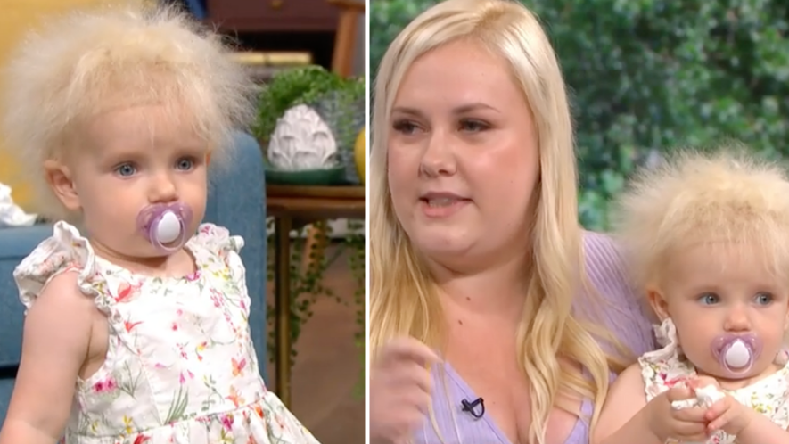 Oneyearold with rare uncombable hair syndrome  Daily Mail Online