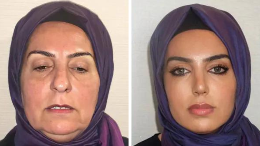 A 68-year-old woman from Turkey shocks with before and after plastic surgery  transformation in TikTok video