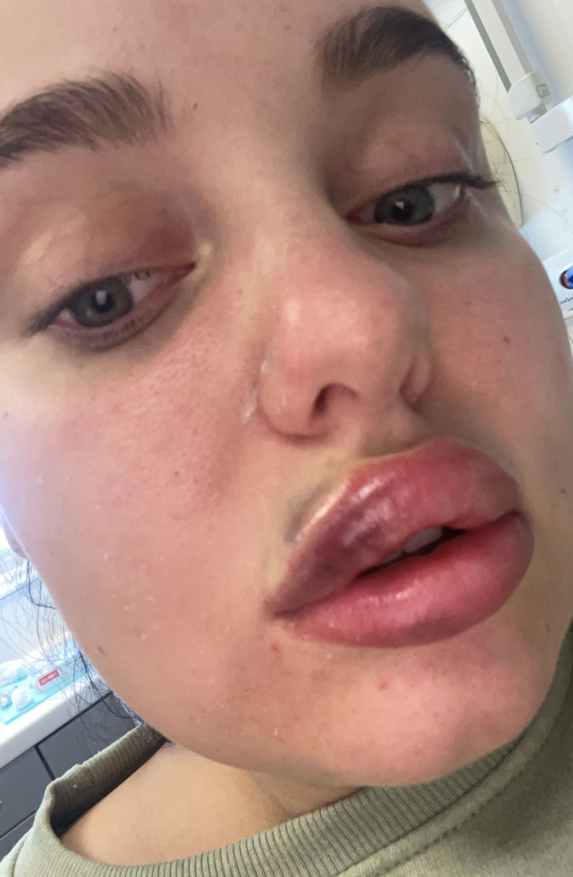 Botched Lip Filler Reddit - 6aujxvg