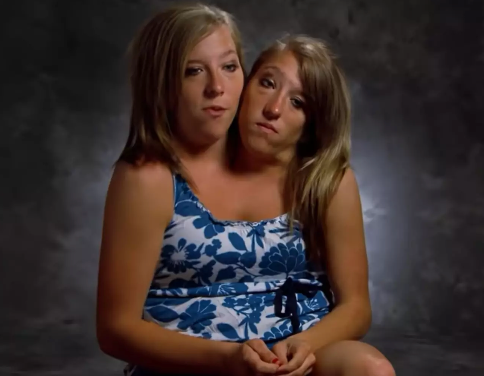 Conjoined twins Britt and Abby are now married! : r/BeAmazed