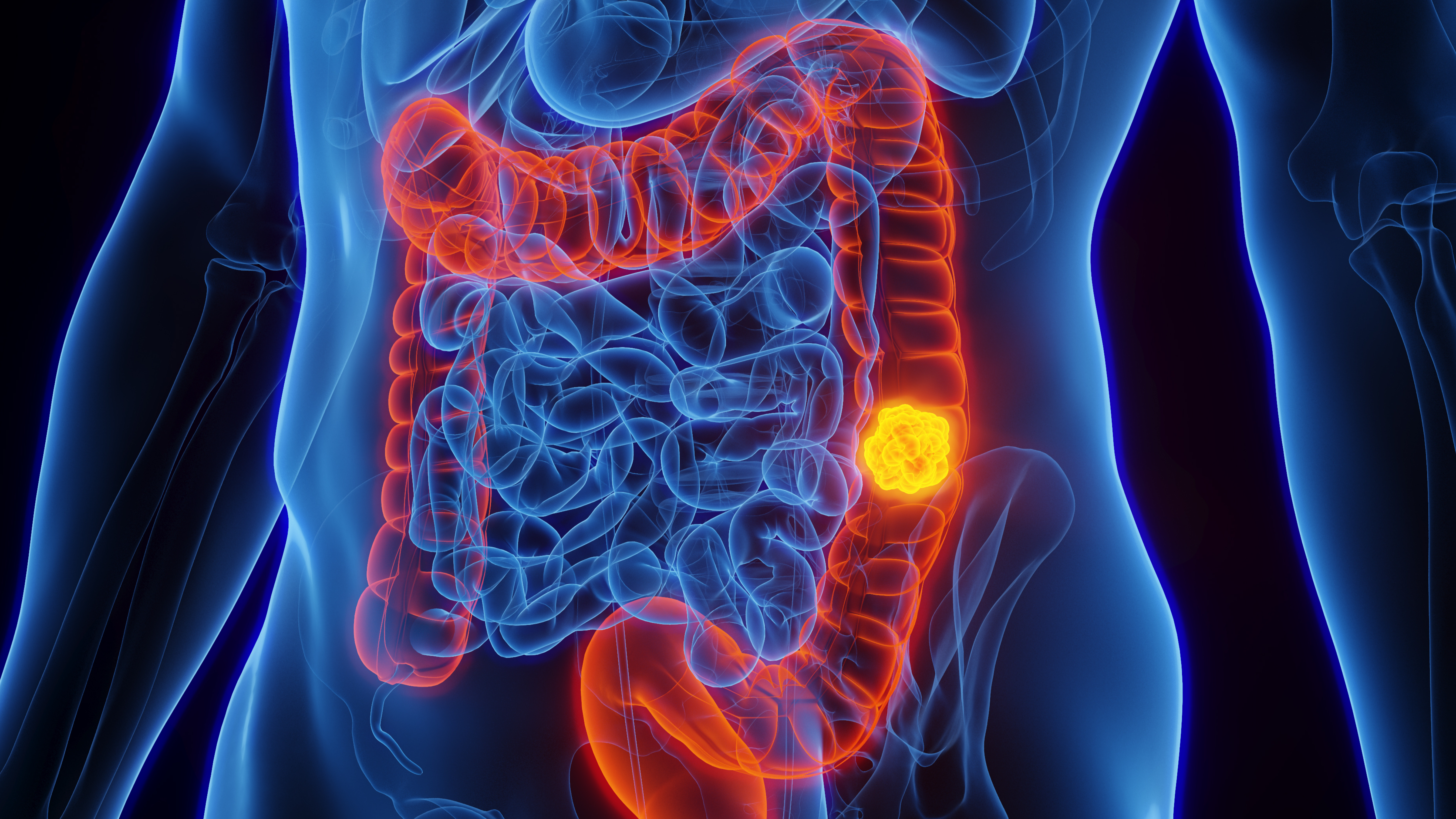 Woman with stage four colon cancer reveals five symptoms she initially  dismissed