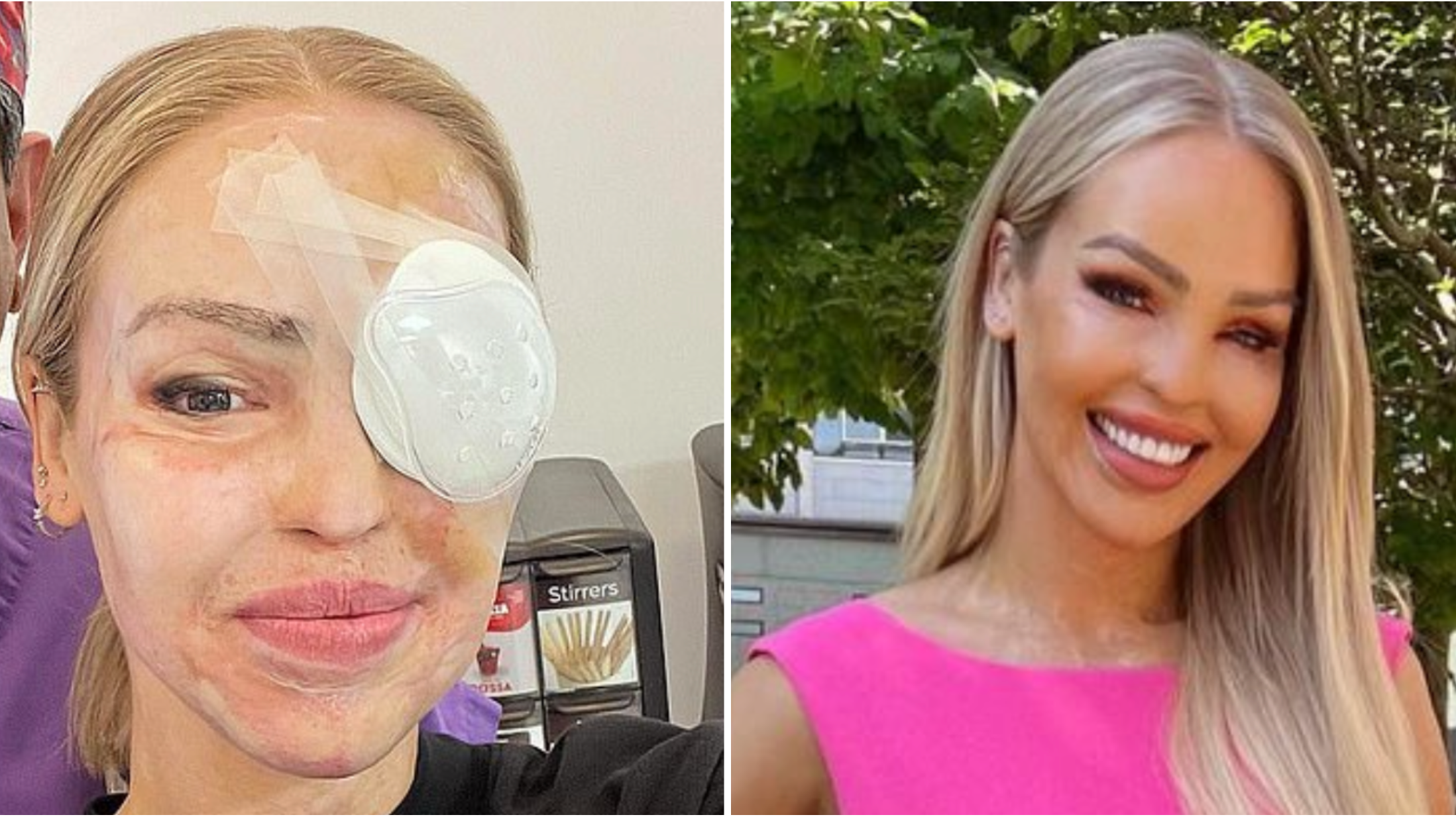 Katie Piper says she is making the best of life after her eye is