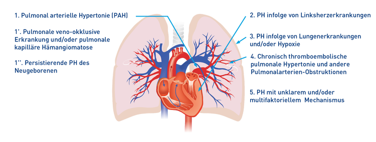 klinische Klassifizierung der pulmonalen Hypertonie