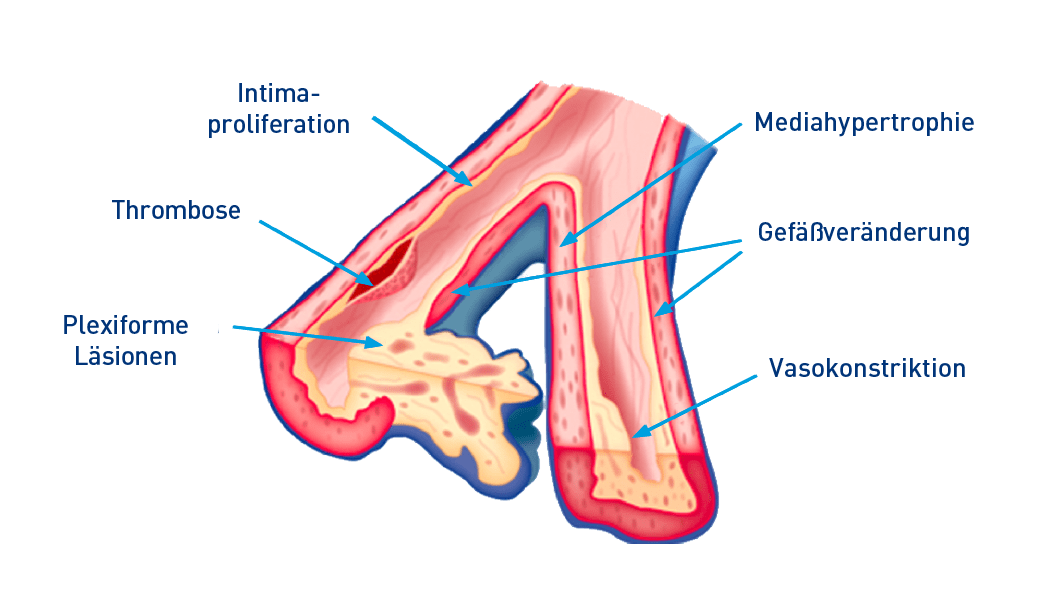Pathologische Merkmale der PAH