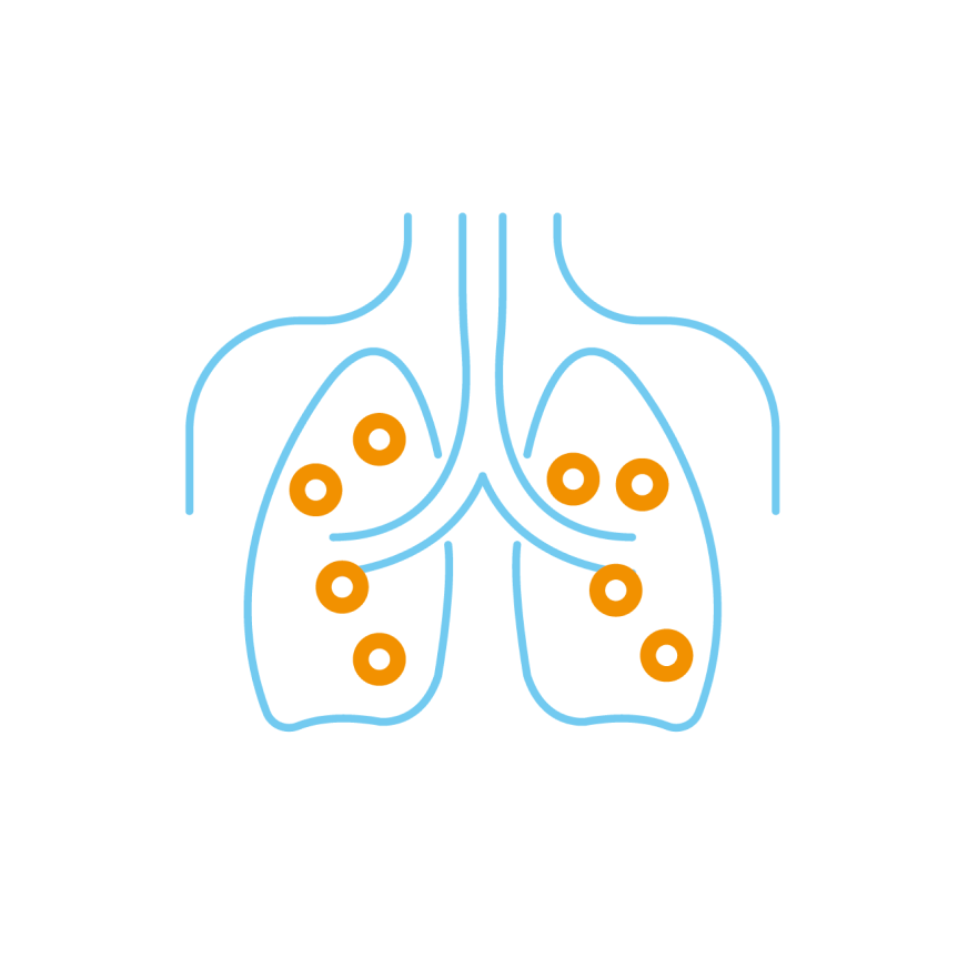 Unterscheidung Bronchialkarzinom