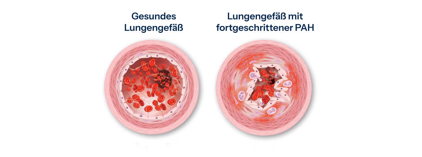 Gefäßveränderungen bei PAH Gefäßveränderungen bei PAH