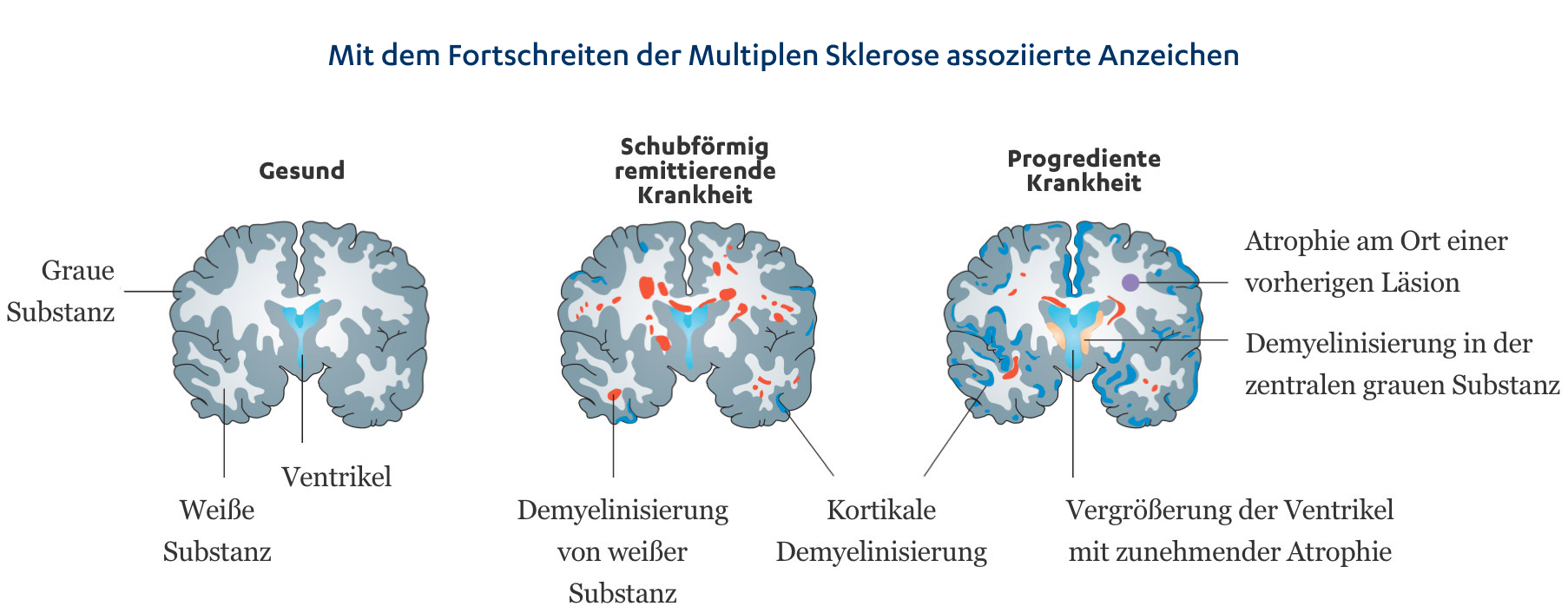 Sturzinterventionen bei multipler sklerose _ multiple sklerose ...