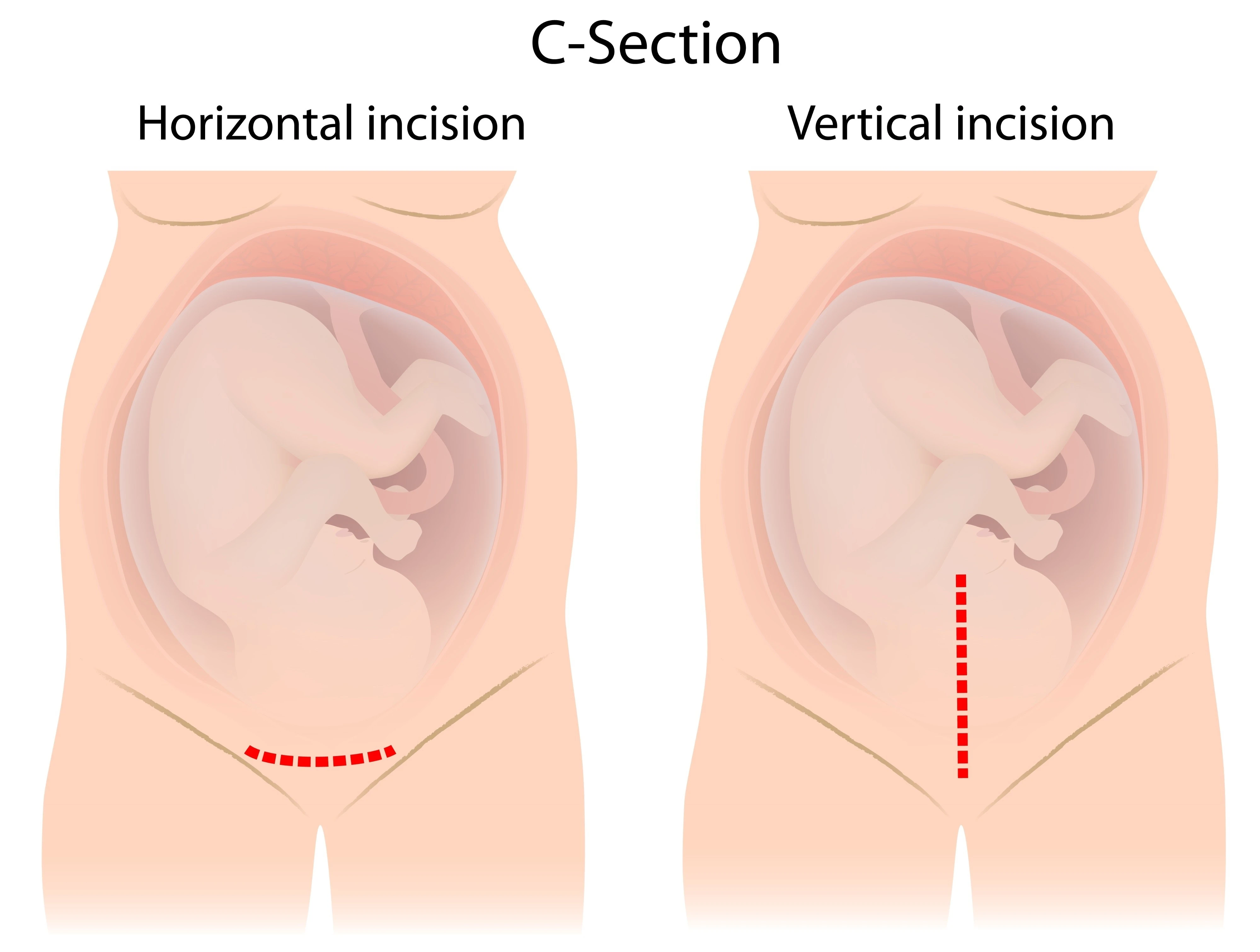 Illustration showing the difference between C-section horizontal and vertical incisions.