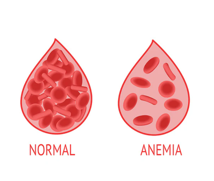 Ilustración comparativa de glóbulos rojos normales y glóbulos rojos con anemia mostrando la diferencia en su estructura.
