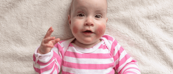 Baby In Pink And White Striped Shirt On White Surface With Rash On Cheeks