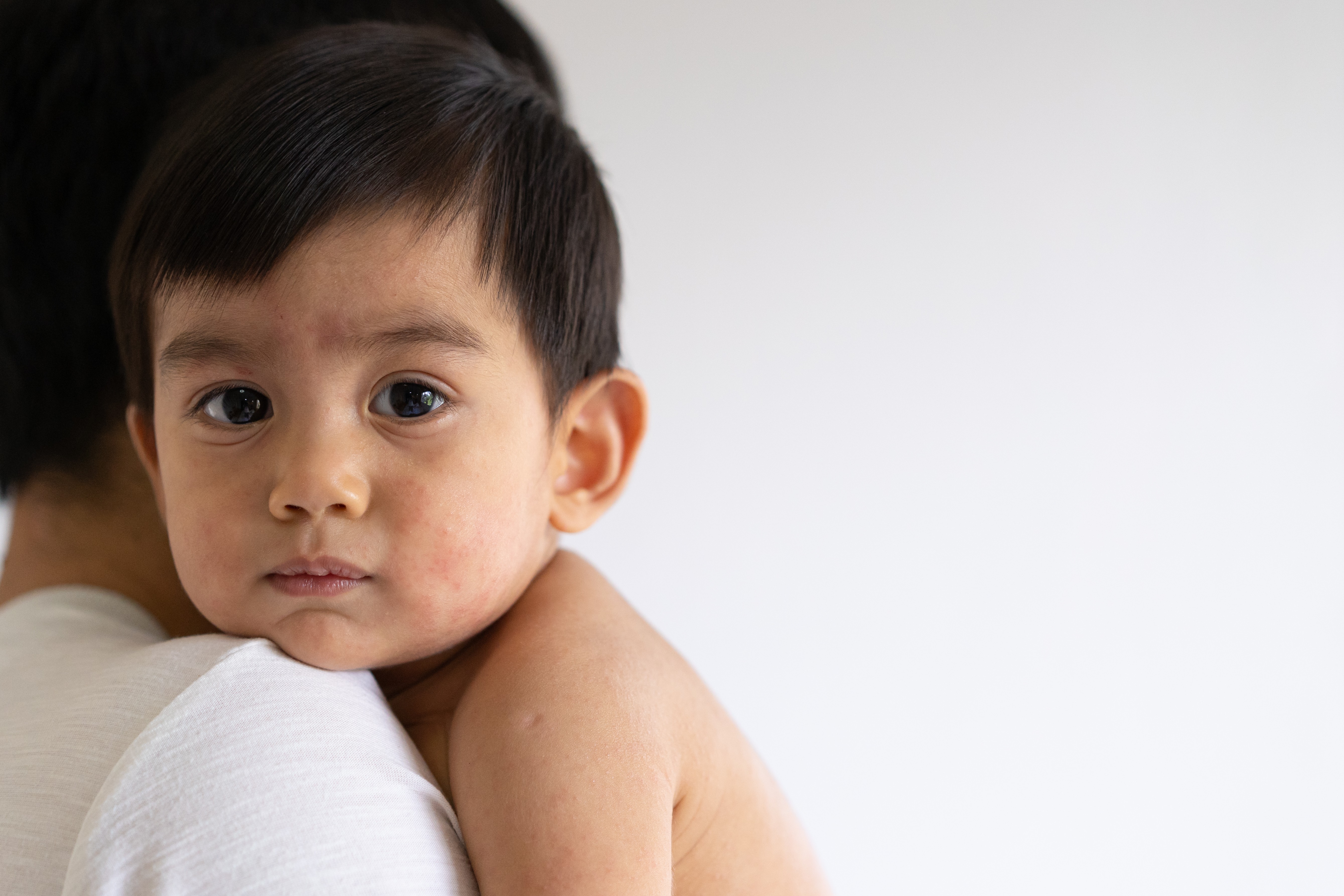 Kenali Tanda Alergi Susu Sapi dan Masalah Pencernaan pada Si Kecil