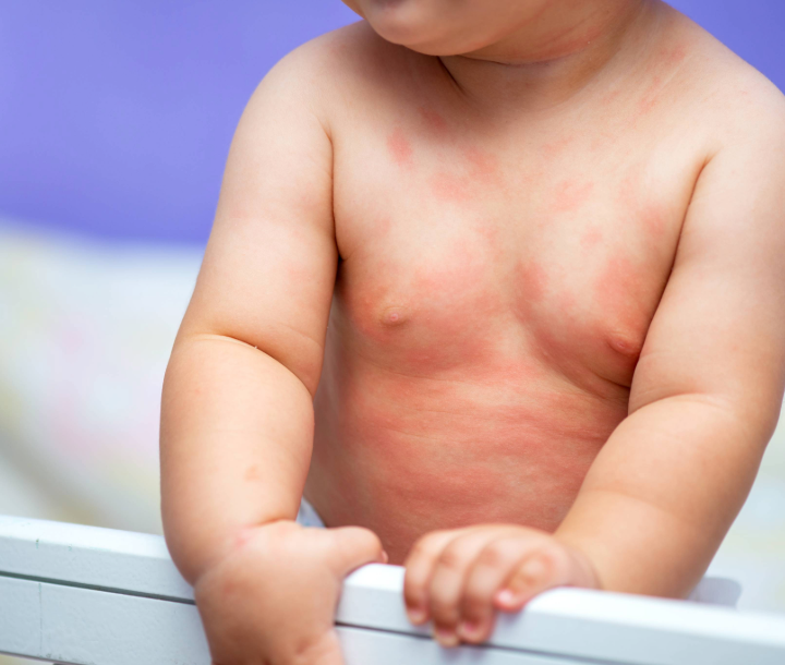 Bebé con erupción y enrojecimiento en la piel, mostrando síntomas de alergia a la proteína de la leche de vaca.