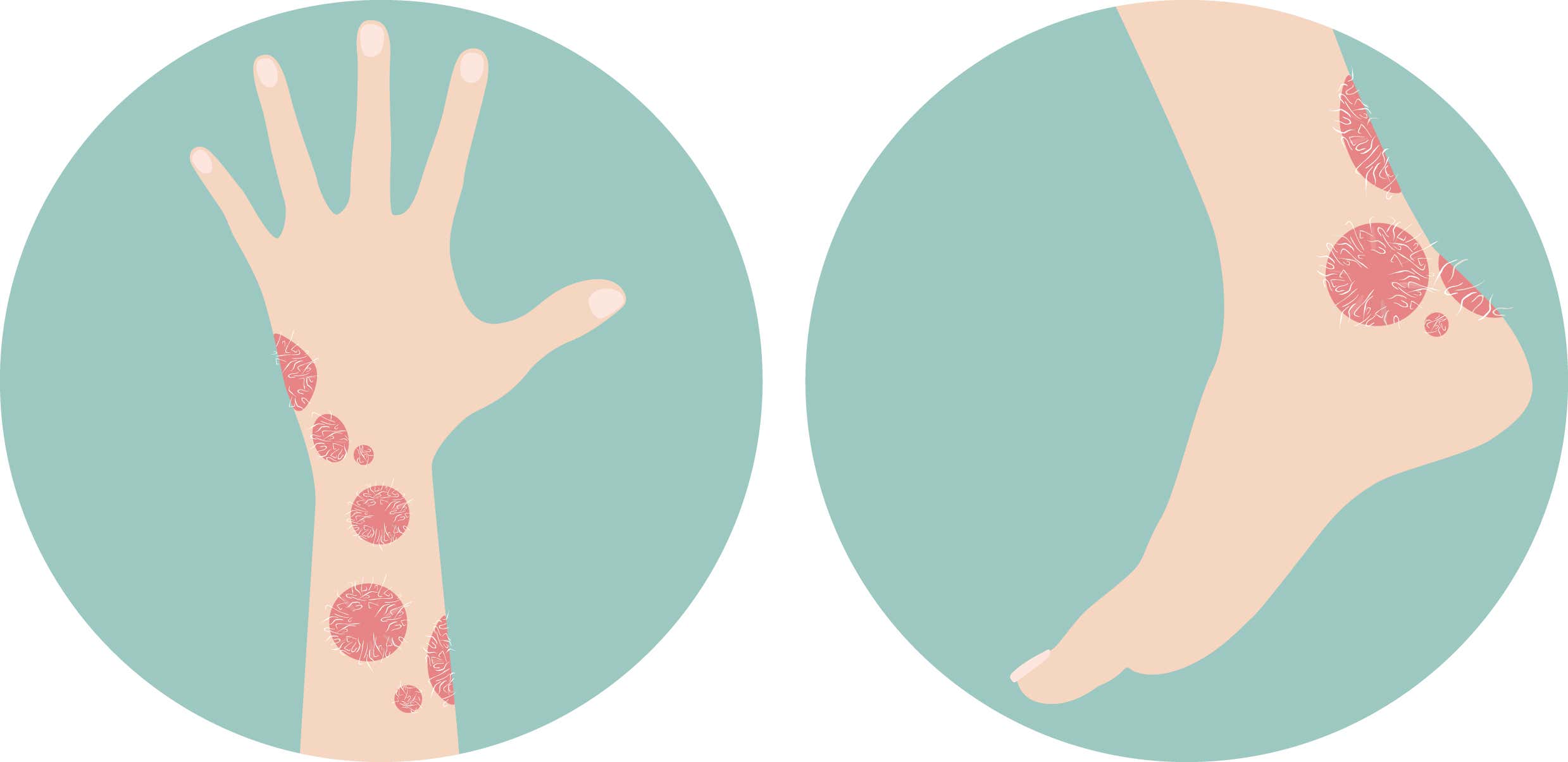 Drawing of a hand and foot with psoriasis