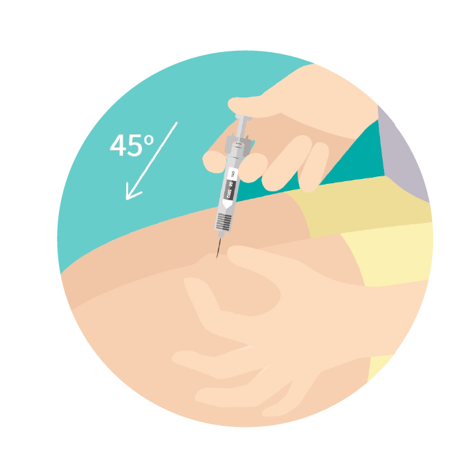 צביטה של העור בקדמת הירך והחדרת המח ב45 מעלות